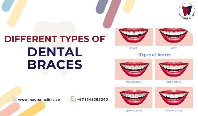 What Are The Different Types Of Dental Braces And Their Pros And Cons