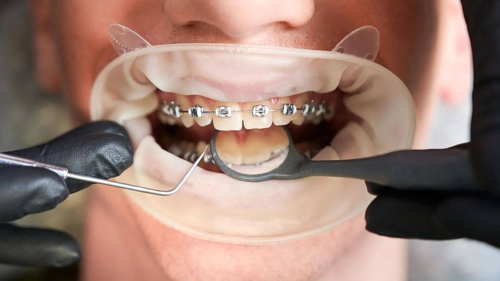 Patient in dental chair during teeth extraction consultation
