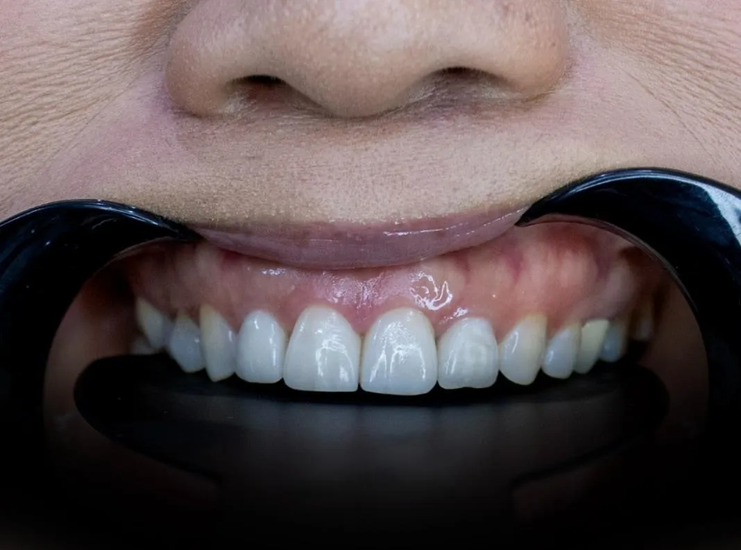 Smile transformation 5 - After