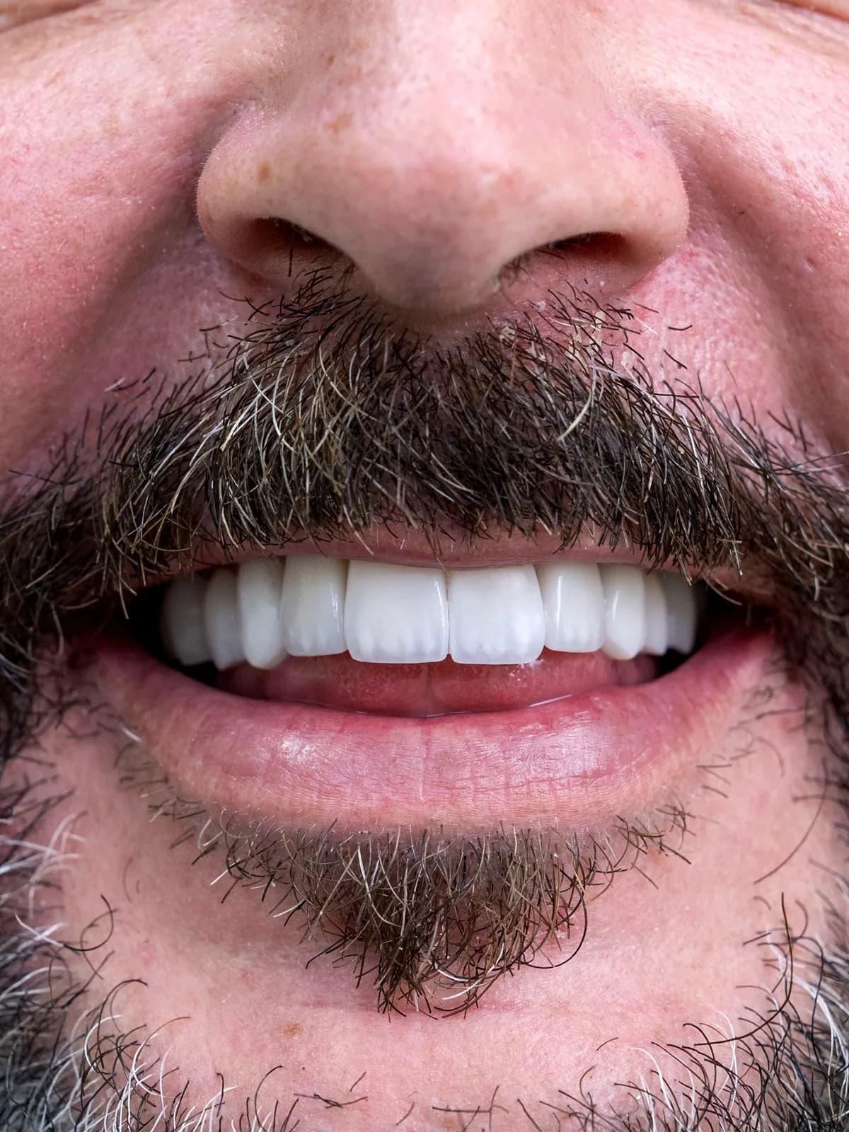 Smile transformation 7 - After