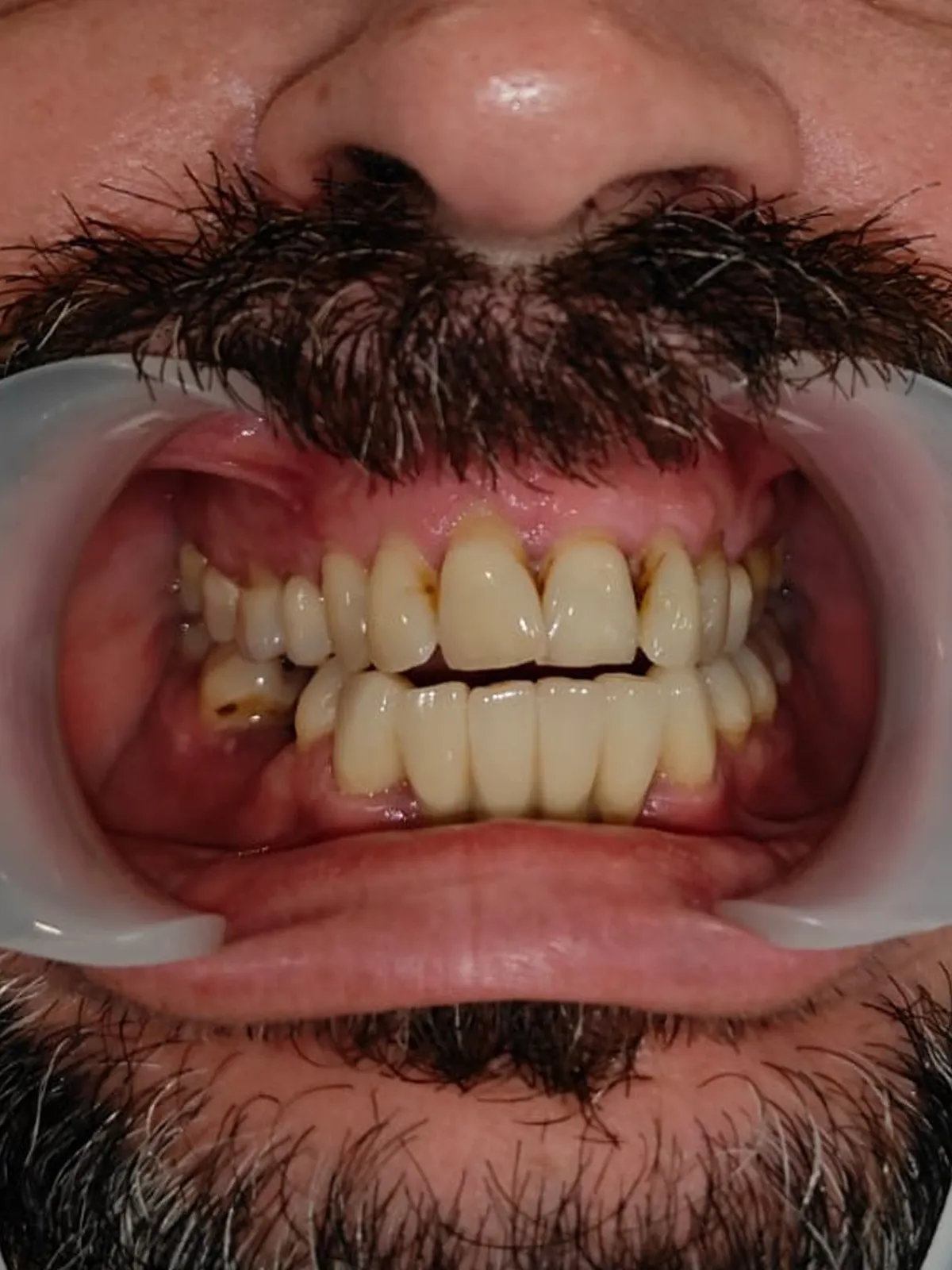 Smile transformation 7 - Before