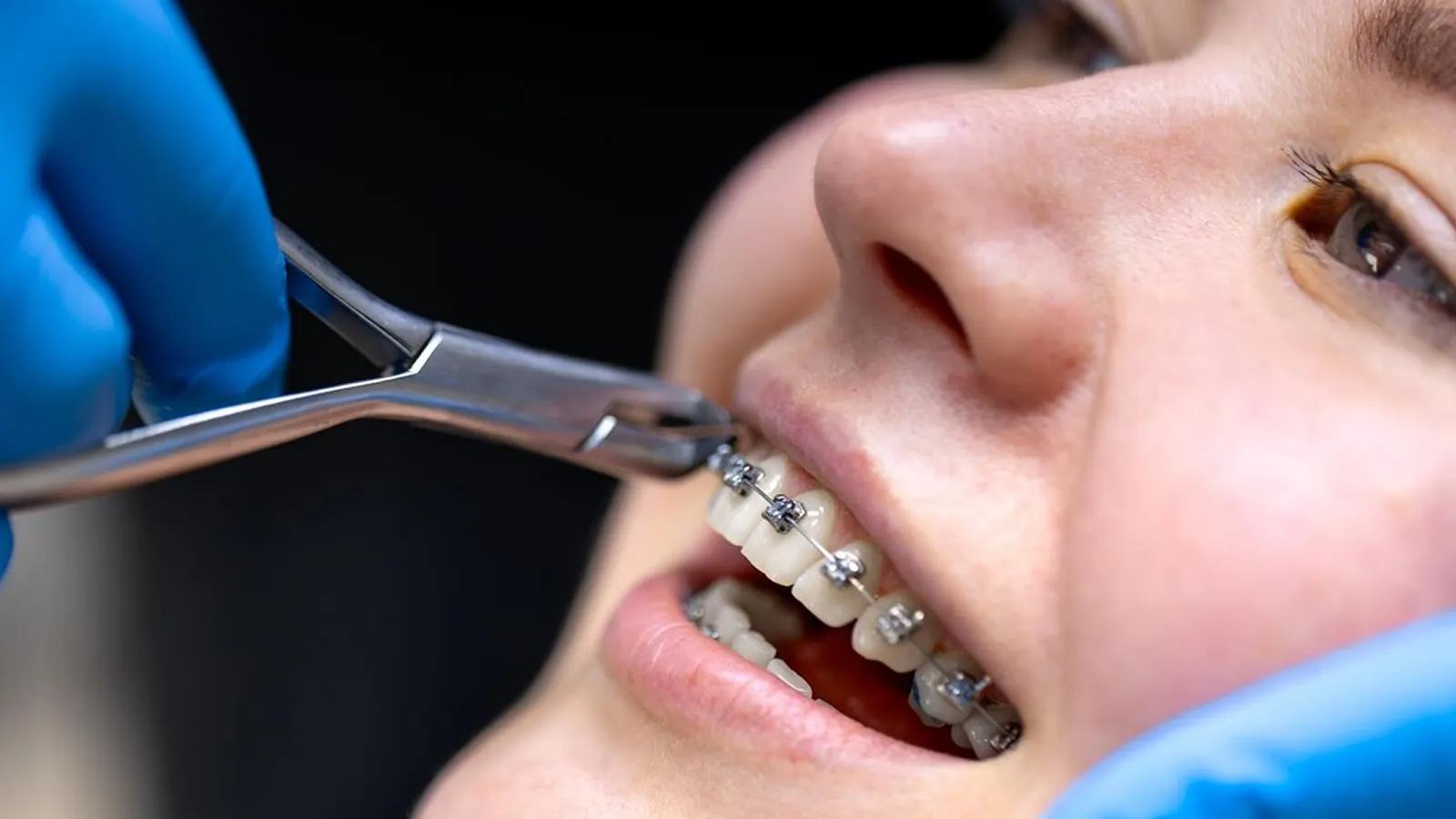 Patient in dental chair during teeth extraction consultation