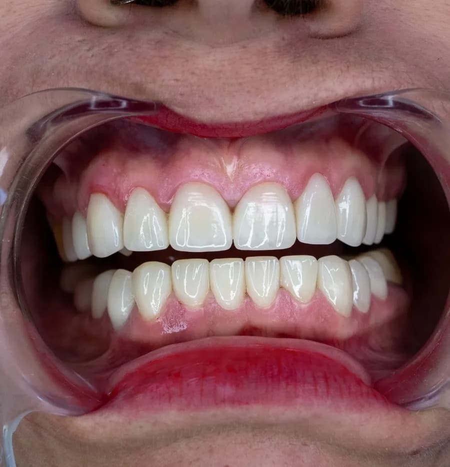 Smile transformation 1 - After