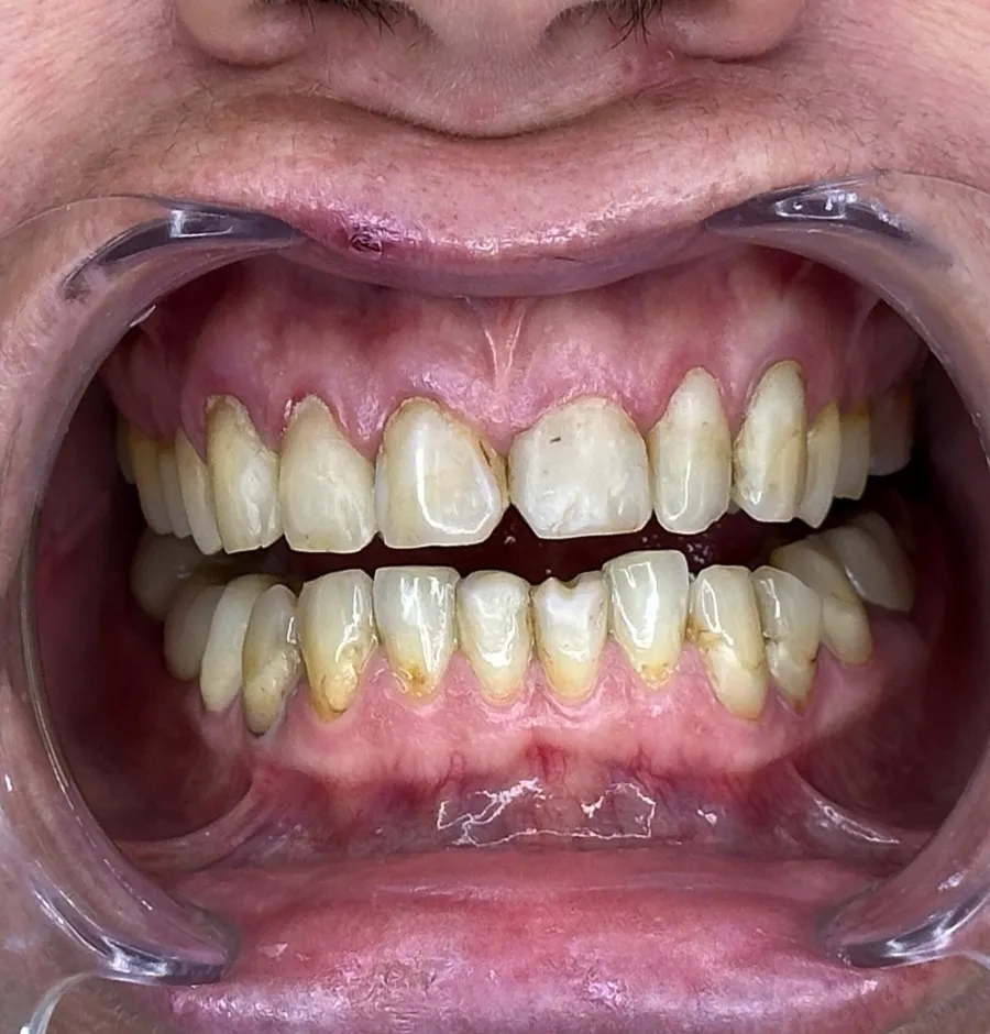 Smile transformation 1 - Before