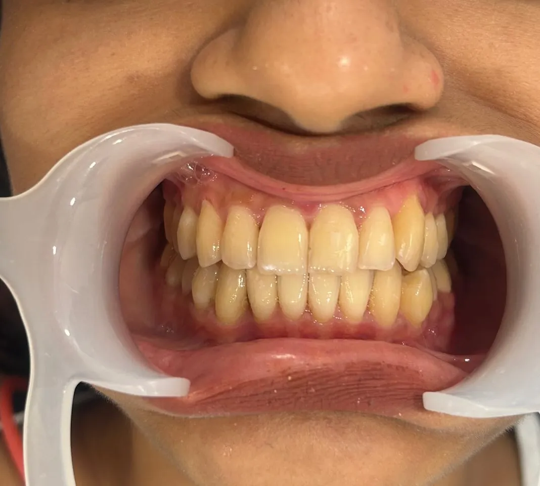 Smile transformation 2 - Before