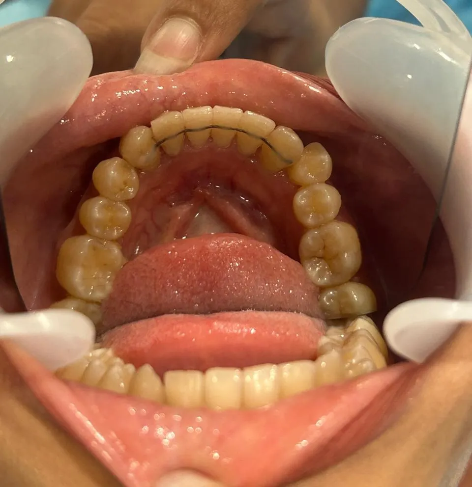 Smile transformation 4 - Before