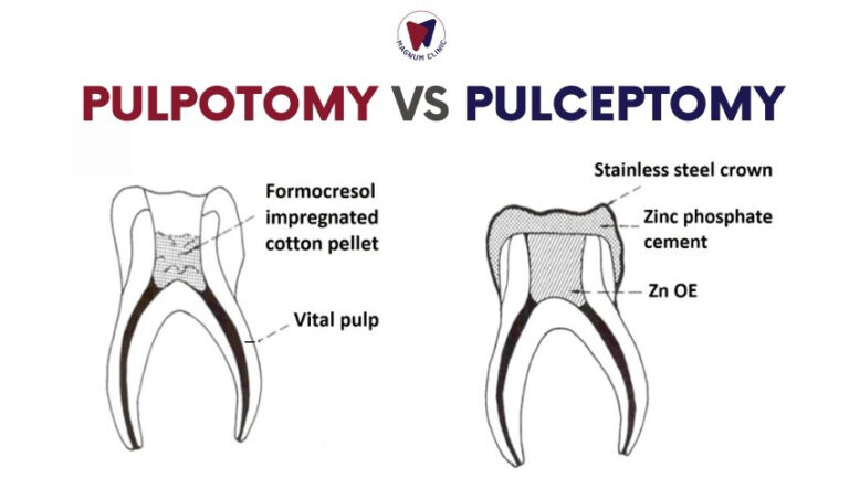 Pulpectomy vs Pulpotomy: Which Procedure Best For Your Teeth