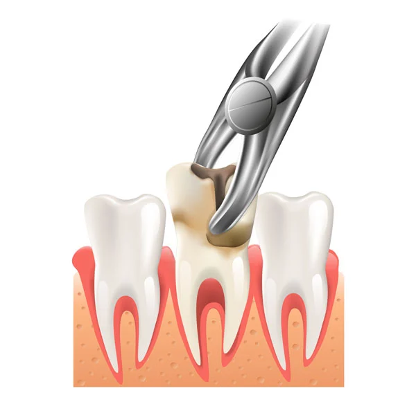 teeth removal image