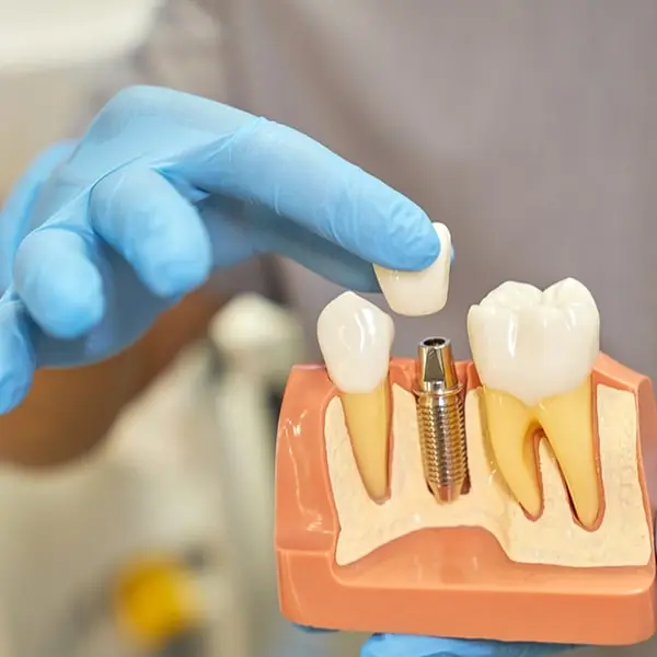 Sameday dental implants image