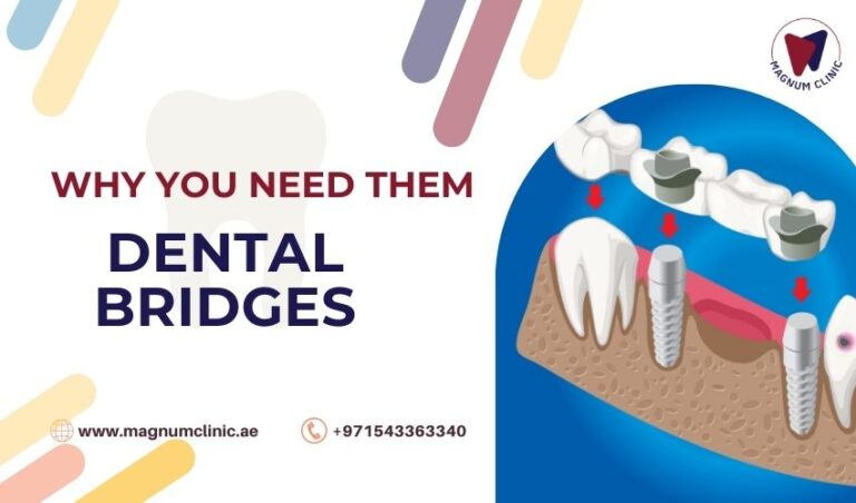 Dental bridges: Why You Need Them, Types, Procedure and Advantages