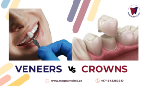 Veneers VS Crowns - Pros And Cons, Difference Between Veneers And Crowns