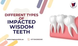 6 Different Types of Impacted Wisdom Teeth | Magnum Clinic