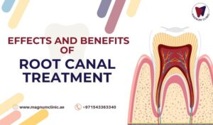 Long-Term Effects And Benefits of Root Canal Treatment